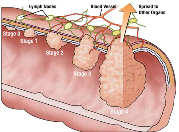 Image result for image of colorectal cancer