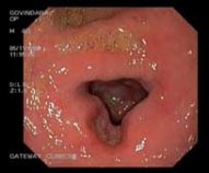 Active ulcer with deformity and mild narrowing in part 1 duodenum