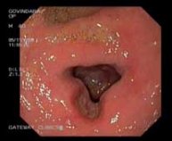 Active ulcer with deformity and mild narrowing in part 1 duodenum