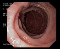 Granular mucosa in 2nd part duodenum