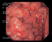 Gastritis with patchy erosion