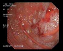 Gastritis with patchy erosion