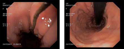 Status transhiatal oesophagectomy with cervical Oesophagogastric anastomosis