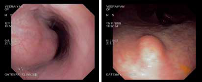 Sub mucosal swelling in oesophagus. submucosal nodule along the lesser curvature